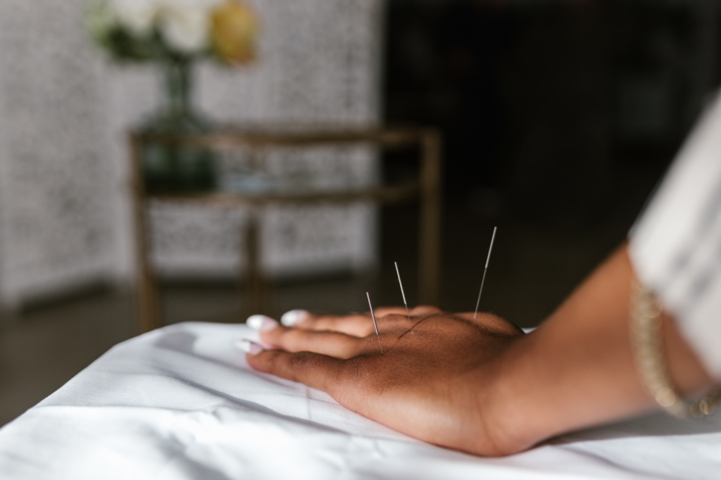 Acupuncturist places needles
