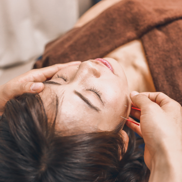 Patient receiving acupuncture