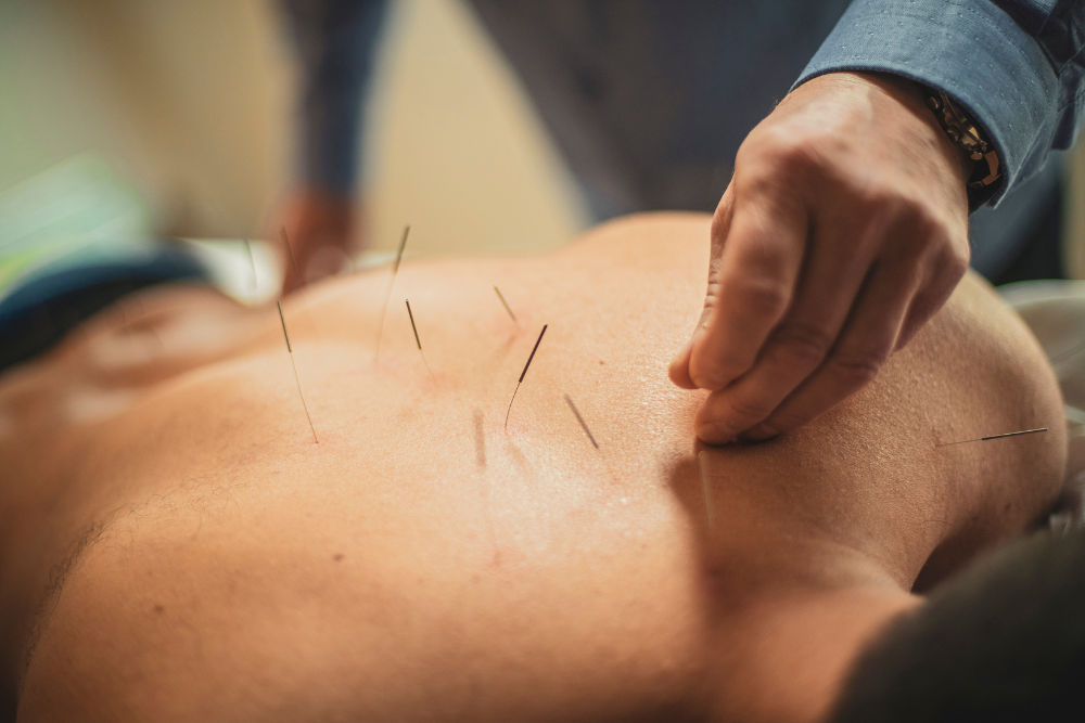 Acupuncturist placing needles